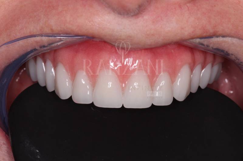 Implante dentário, implante zigomático, prótese protocolo