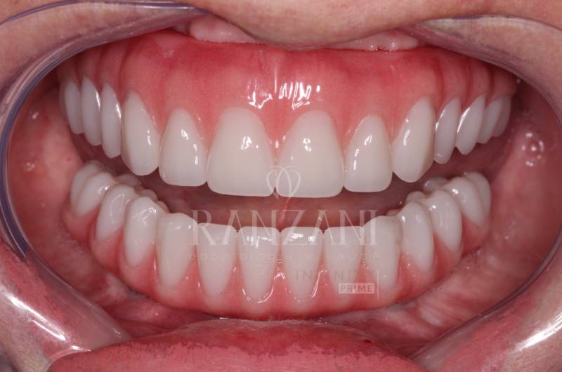 Implante dentário, implante zigomático, prótese protocolo