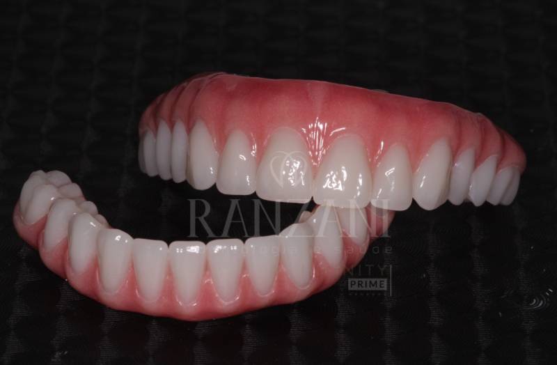 Implante dentário, implante zigomático, prótese protocolo