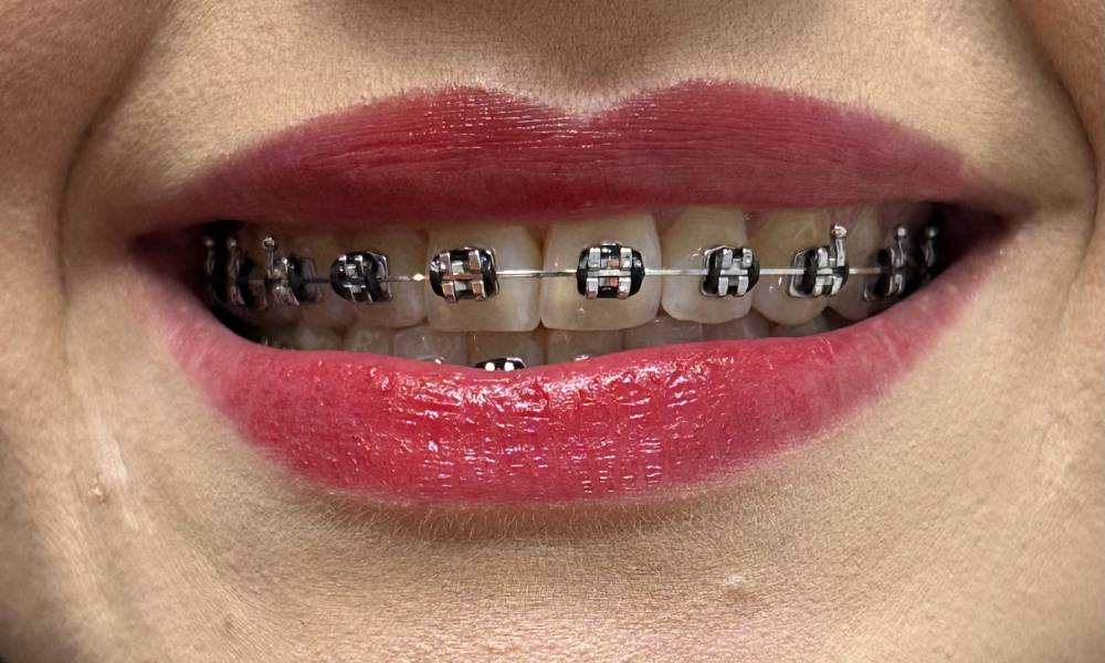 Aparelho dental Vargem Grande do Sul