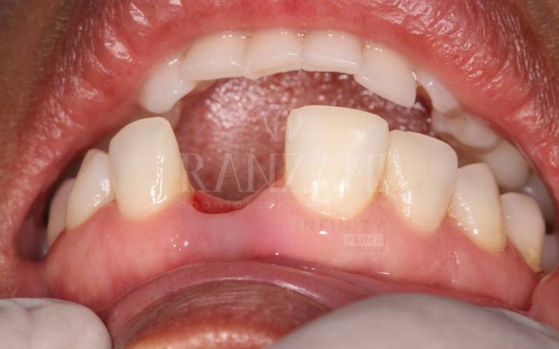 Implantes Dentários Vargem grande do Sul -SP