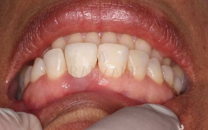 Implantes Dentários Vargem grande do Sul -SP