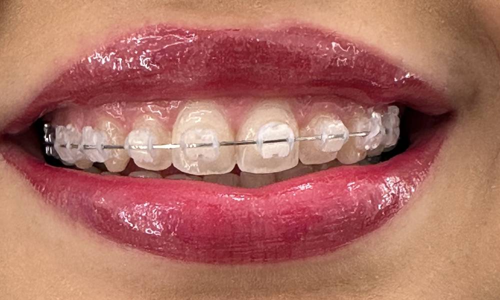 Aparelho dental Vargem Grande do Sul