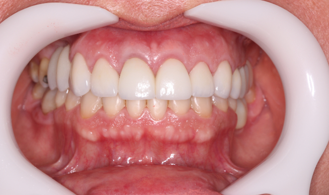 Lente de Porcelana Dentista vgs