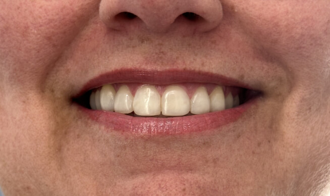 Lente de Resina Dentista vgs