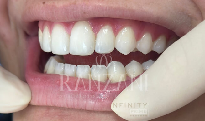 Lente de Resina Dentista vgs