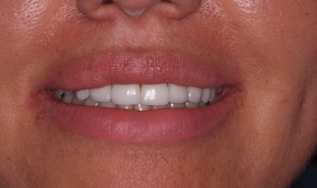 Lente de Porcelana Dentista Vargem Grande do Sul