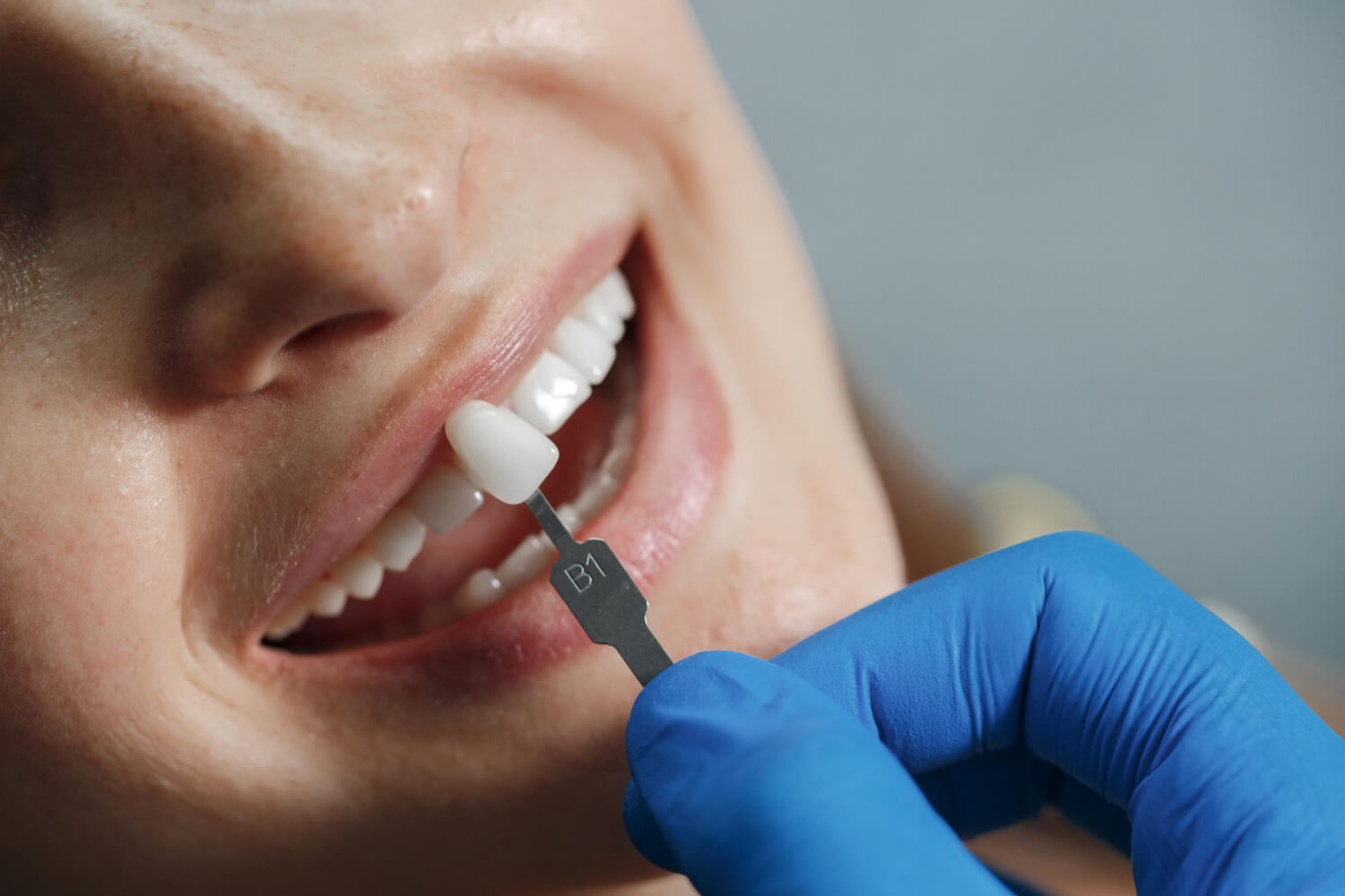 Clareamento Dental: A beleza de um sorriso mais branco